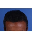 After Hair Transplant&nbsp;Front